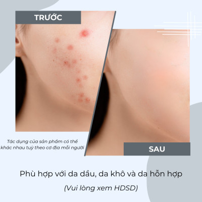 Mặt Nạ Đất Sét Tro Núi Lửa JeJu Ngừa Mụn Sạch Sâu POP
