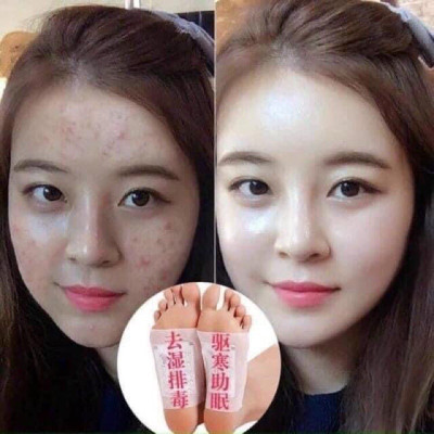 Hộp 50 Miếng Dán Thải Độc Bàn Chân Ngải Cứu Bắc Kinh - An Toàn,Hiệu Qủa 6-8 Tiếng